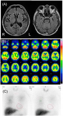 Case report: Delusional infestation in dementia with Lewy bodies